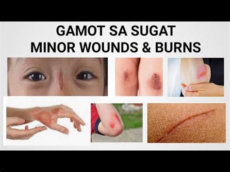 sugat sa tuhod|GAMOT SA SUGAT, MINOR WOUNDS AND BURNS .
